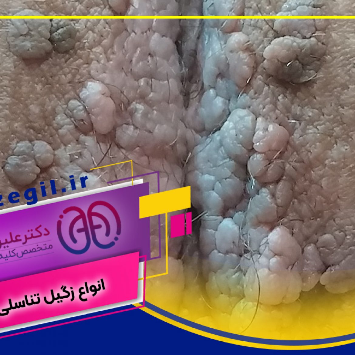 انواع زگیل واژن درمان زگیل تناسلی در اصفهان،زگیل تناسلی،زگیل اصفهان،زگیل درمانی